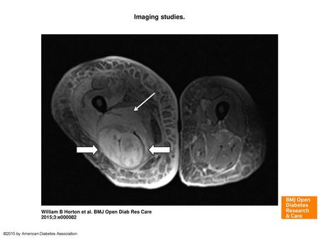 Imaging studies. Imaging studies. Proton density fat-saturated MRI sequence demonstrates an increased signal within the semimembranosus and biceps femoris.