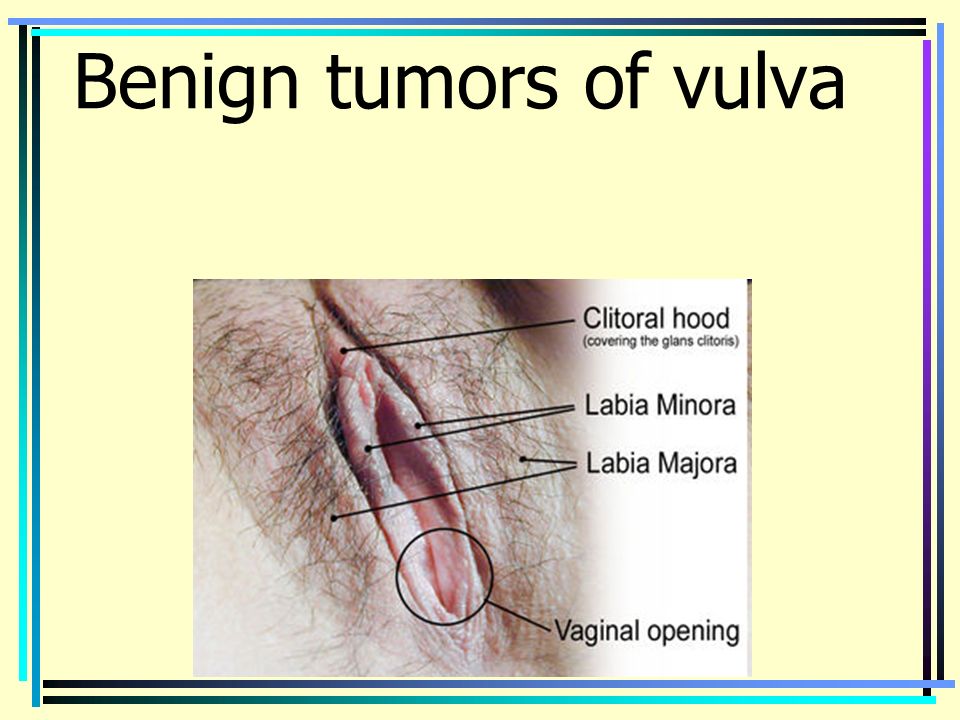 Benign Tumors In Vagina 9