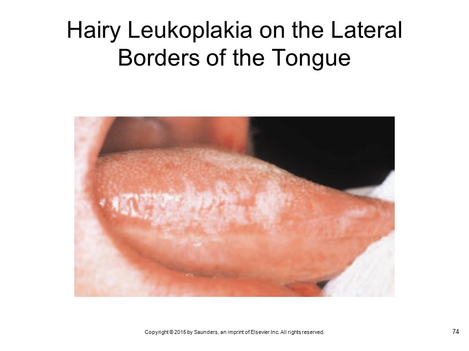 Hairy Leukopenia 9