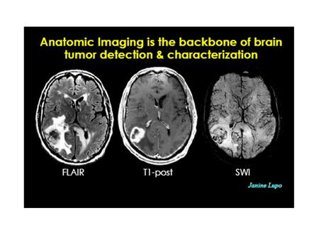 CT Scan Reveals a mass that may or may not be enhanced with use of contrast medium. On CT, low-grade gliomas may be isodense with normal brain parenchyma.