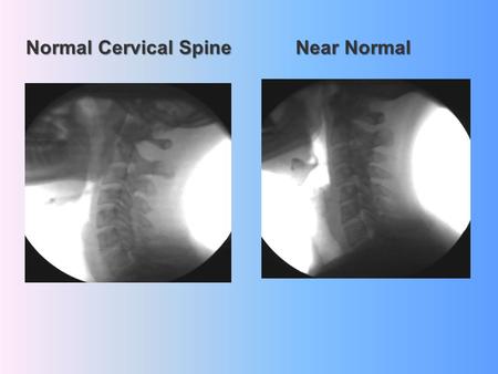 Normal Cervical Spine Near Normal. Normal Cervical Spine Phase 1 Degeneration.