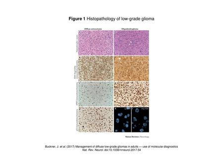 Figure 1 Histopathology of low-grade glioma
