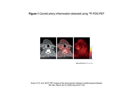 Figure 1 Carotid artery inflammation detected using 18F-FDG-PET