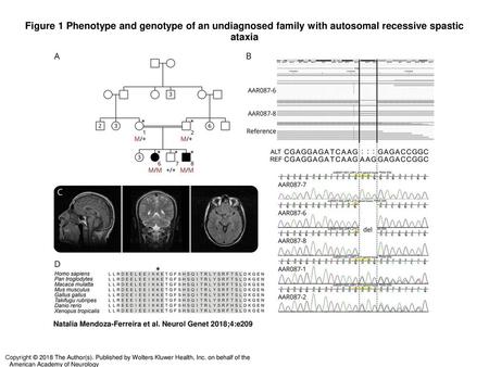 Figure 1 Phenotype and genotype of an undiagnosed family with autosomal recessive spastic ataxia Phenotype and genotype of an undiagnosed family with autosomal.