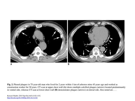 Fig. 2. Pleural plaques in 75-year-old man who lived for 2 years within 1 km of asbestos mine 45 years ago and worked as construction worker for 30 years.