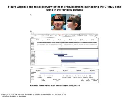 Figure Genomic and facial overview of the microduplications overlapping the GRIN2D gene found in the retrieved patients Genomic and facial overview of.