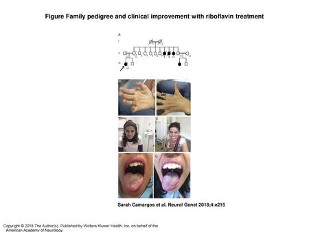 Figure Family pedigree and clinical improvement with riboflavin treatment Family pedigree and clinical improvement with riboflavin treatment (A) The proband.