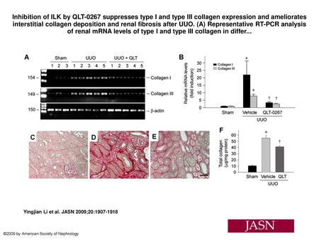 Inhibition of ILK by QLT-0267 suppresses type I and type III collagen expression and ameliorates interstitial collagen deposition and renal fibrosis after.
