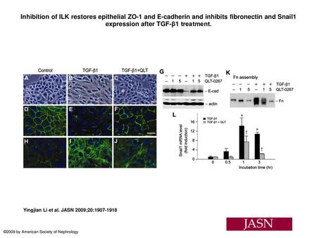 Inhibition of ILK restores epithelial ZO-1 and E-cadherin and inhibits fibronectin and Snail1 expression after TGF-β1 treatment. Inhibition of ILK restores.