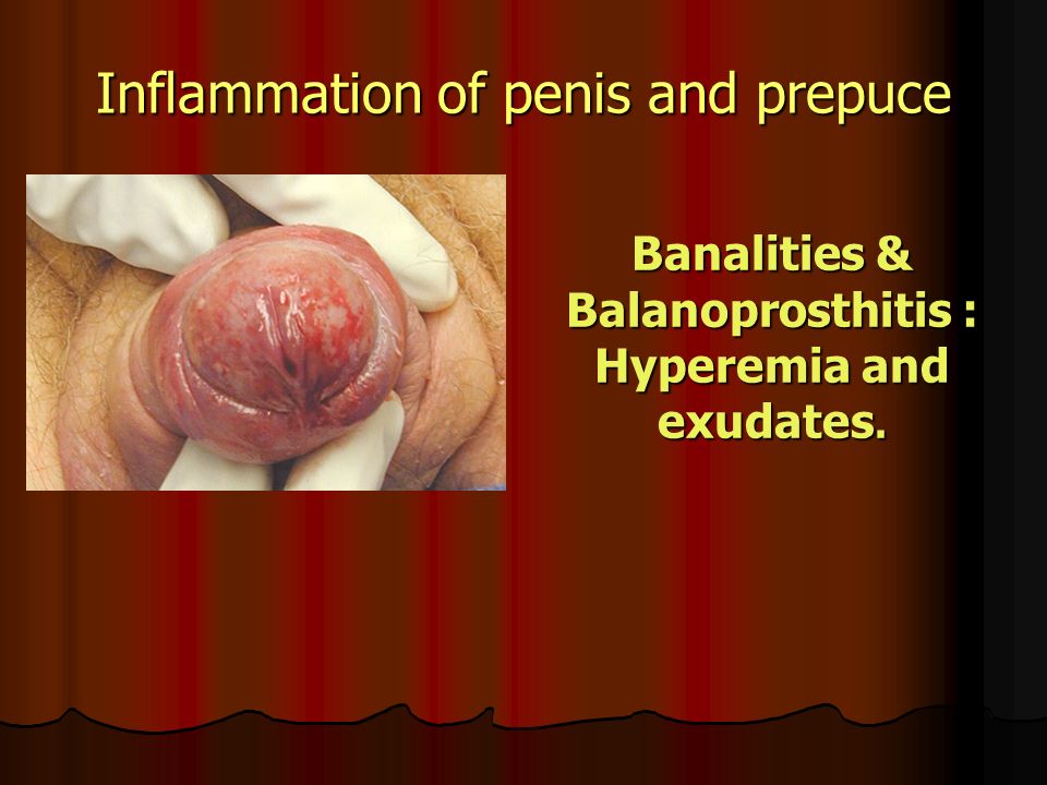 Inflammation Of Penis 22