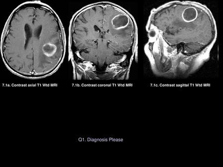 7.1b. Contrast coronal T1 Wtd MRI 7.1c. Contrast sagittal T1 Wtd MRI