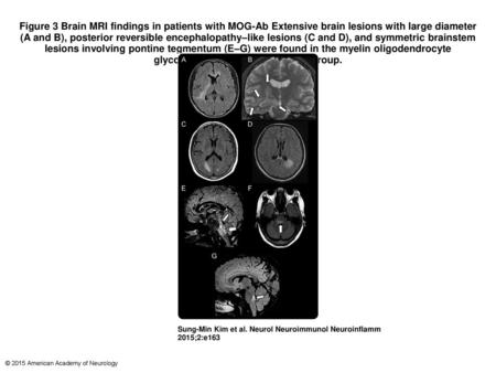 Figure 3 Brain MRI findings in patients with MOG-Ab Extensive brain lesions with large diameter (A and B), posterior reversible encephalopathy–like lesions.