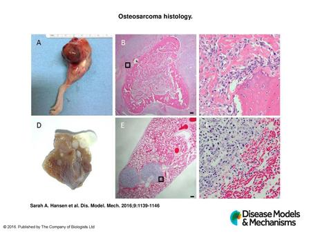 Osteosarcoma histology.