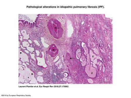 Pathological alterations in idiopathic pulmonary fibrosis (IPF).