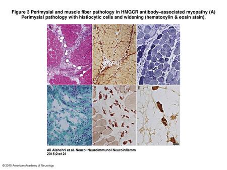 Figure 3 Perimysial and muscle fiber pathology in HMGCR antibody–associated myopathy (A) Perimysial pathology with histiocytic cells and widening (hematoxylin.