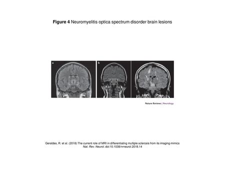 Figure 4 Neuromyelitis optica spectrum disorder brain lesions