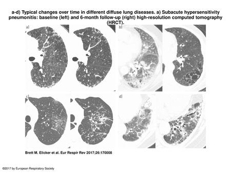 a-d) Typical changes over time in different diffuse lung diseases