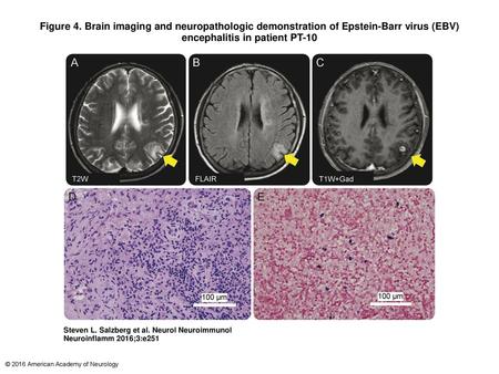 Figure 4. Brain imaging and neuropathologic demonstration of Epstein-Barr virus (EBV) encephalitis in patient PT-10 Brain imaging and neuropathologic demonstration.