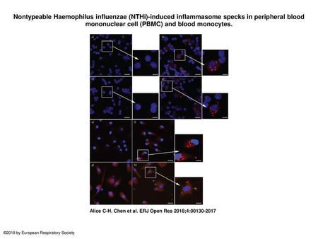 Nontypeable Haemophilus influenzae (NTHi)-induced inflammasome specks in peripheral blood mononuclear cell (PBMC) and blood monocytes. Nontypeable Haemophilus.