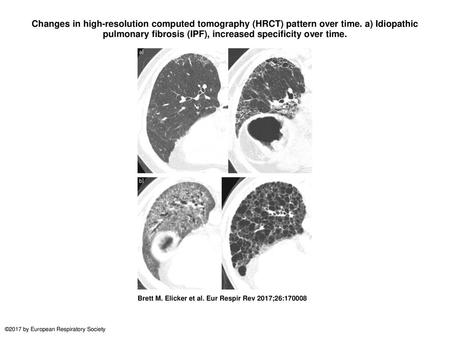 Changes in high-resolution computed tomography (HRCT) pattern over time. a) Idiopathic pulmonary fibrosis (IPF), increased specificity over time. Changes.