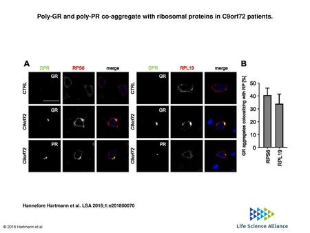 Poly-GR and poly-PR co-aggregate with ribosomal proteins in C9orf72 patients. Poly-GR and poly-PR co-aggregate with ribosomal proteins in C9orf72 patients.