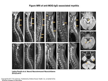 Figure MRI of anti-MOG-IgG–associated myelitis