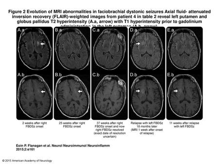 Figure 2 Evolution of MRI abnormalities in faciobrachial dystonic seizures Axial fluid- attenuated inversion recovery (FLAIR)-weighted images from patient.