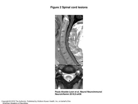 Figure 2 Spinal cord lesions