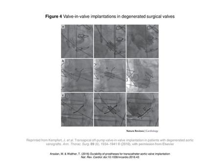 Figure 4 Valve-in-valve implantations in degenerated surgical valves