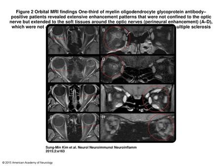 Figure 2 Orbital MRI findings One-third of myelin oligodendrocyte glycoprotein antibody–positive patients revealed extensive enhancement patterns that.