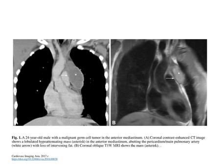 Fig. 1. A 24-year-old male with a malignant germ cell tumor in the anterior mediastinum. (A) Coronal contrast-enhanced CT image shows a lobulated hypoattenuating.