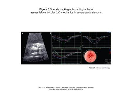 Figure 6 Speckle tracking echocardiography to