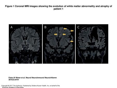 Figure 1 Coronal MRI images showing the evolution of white matter abnormality and atrophy of patient 1 Coronal MRI images showing the evolution of white.