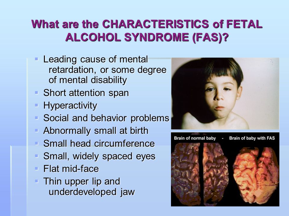 Facial Deformaties Of Fetal Alcohol Syndrome Photo Porn
