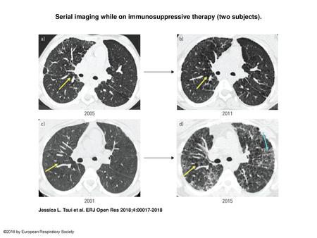 Serial imaging while on immunosuppressive therapy (two subjects).