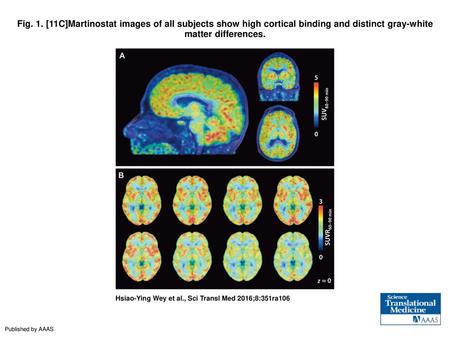 Fig. 1. [11C]Martinostat images of all subjects show high cortical binding and distinct gray-white matter differences. [11C]Martinostat images of all subjects.