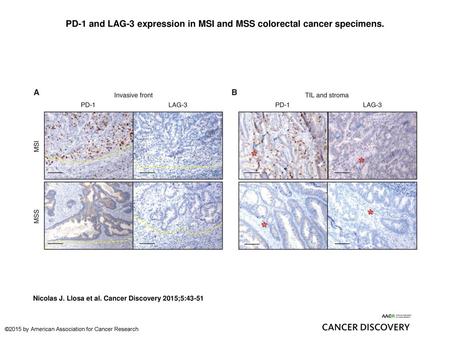 PD-1 and LAG-3 expression in MSI and MSS colorectal cancer specimens.