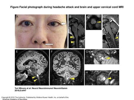Figure Facial photograph during headache attack and brain and upper cervical cord MRI Facial photograph during headache attack and brain and upper cervical.