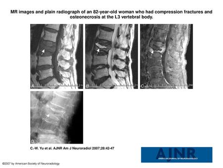 MR images and plain radiograph of an 82-year-old woman who had compression fractures and osteonecrosis at the L3 vertebral body. MR images and plain radiograph.