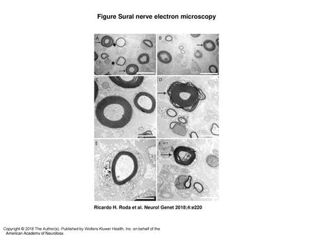 Figure Sural nerve electron microscopy