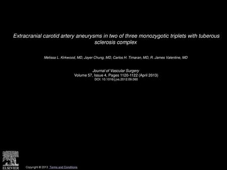 Extracranial carotid artery aneurysms in two of three monozygotic triplets with tuberous sclerosis complex  Melissa L. Kirkwood, MD, Jayer Chung, MD,