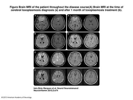 Figure Brain MRI of the patient throughout the disease course(A) Brain MRI at the time of cerebral toxoplasmosis diagnosis (a) and after 1 month of toxoplasmosis.