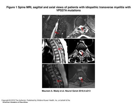 Figure 1 Spine MRI, sagittal and axial views of patients with idiopathic transverse myelitis with VPS37A mutations Spine MRI, sagittal and axial views.