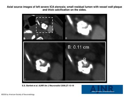 Axial source images of left severe ICA stenosis; small residual lumen with vessel wall plaque and thick calcification on the sides. Axial source images.