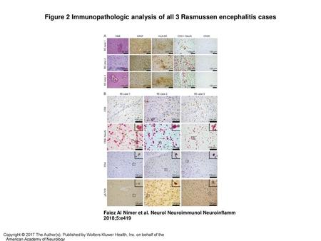 Figure 2 Immunopathologic analysis of all 3 Rasmussen encephalitis cases Immunopathologic analysis of all 3 Rasmussen encephalitis cases (A) Perivascular.