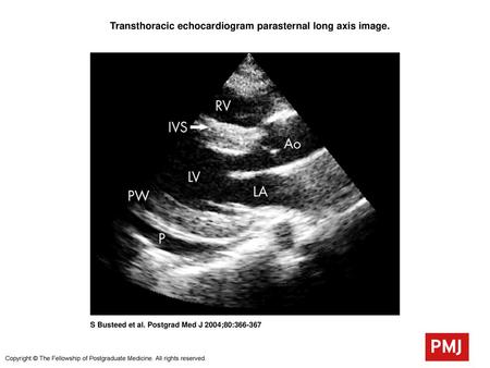 Transthoracic echocardiogram parasternal long axis image.