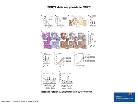 SPRY2 deficiency leads to CRPC