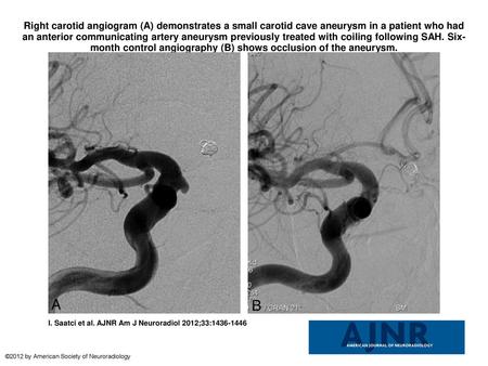 Right carotid angiogram (A) demonstrates a small carotid cave aneurysm in a patient who had an anterior communicating artery aneurysm previously treated.