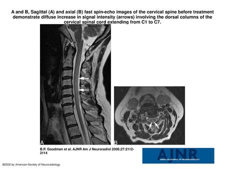 A and B, Sagittal (A) and axial (B) fast spin-echo images of the cervical spine before treatment demonstrate diffuse increase in signal intensity (arrows)