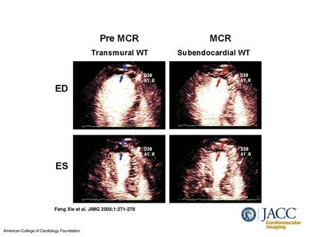 Example of Subendocardial Defects With Normal Transmural WT on Apical 3-Chamber View With RTMCE Apical 3-chamber view of RTMCE with power modulation (iE33,